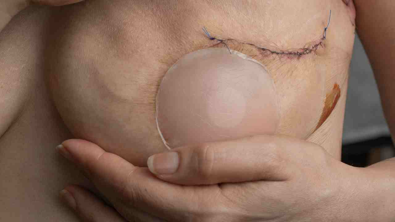 Breast Cancer Surgery What to Expect