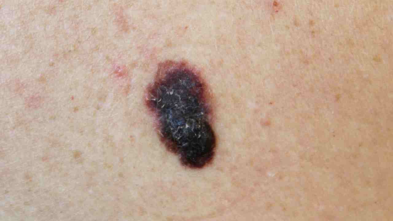 Early Detection of Melanoma Key to a Cure