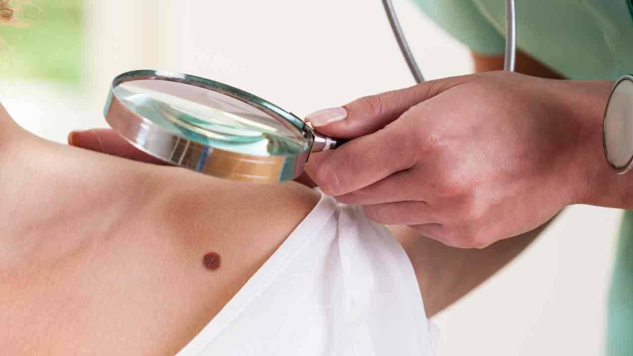 Surgery for Melanoma What to Expect