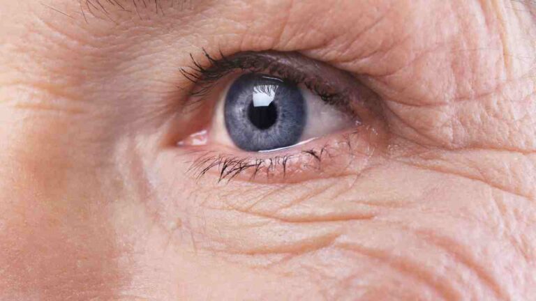 Facial Features in Alzheimer’s Disease