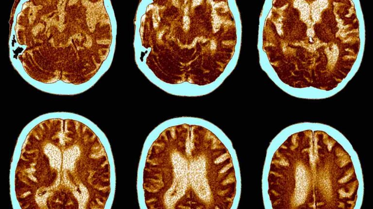 Cognitive Stimulation in Alzheimer’s Disease: Benefits of Activity Books